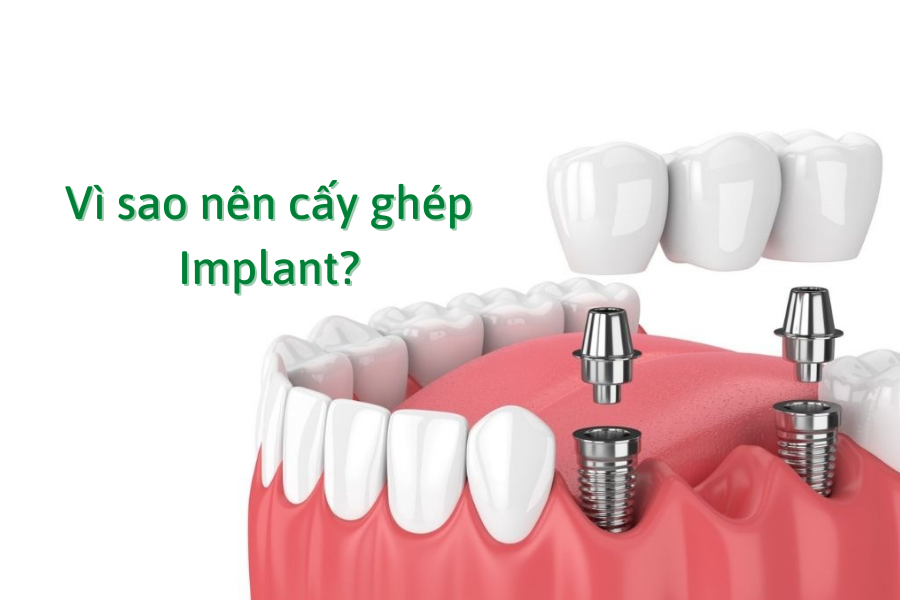 Vì sao nên cấy ghép Implant?